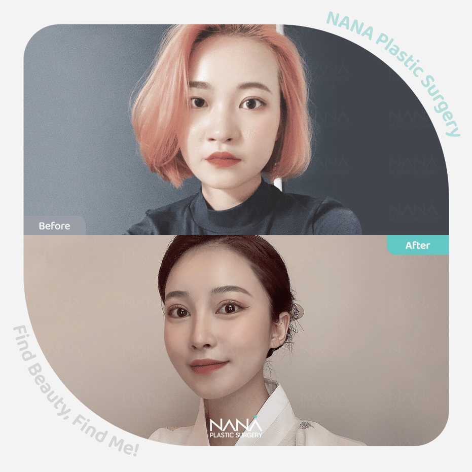 団子鼻や太い鼻の改善のために｜韓国整形NANA美容外科, image size:931x931