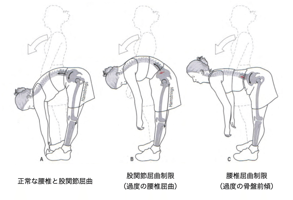 腰部屈曲時に背側から下肢に症状が出現する患者の評価・治療の実際(全２枚) 下部体幹の評価と治療～腰部屈曲時に背側から下肢に症状が出現