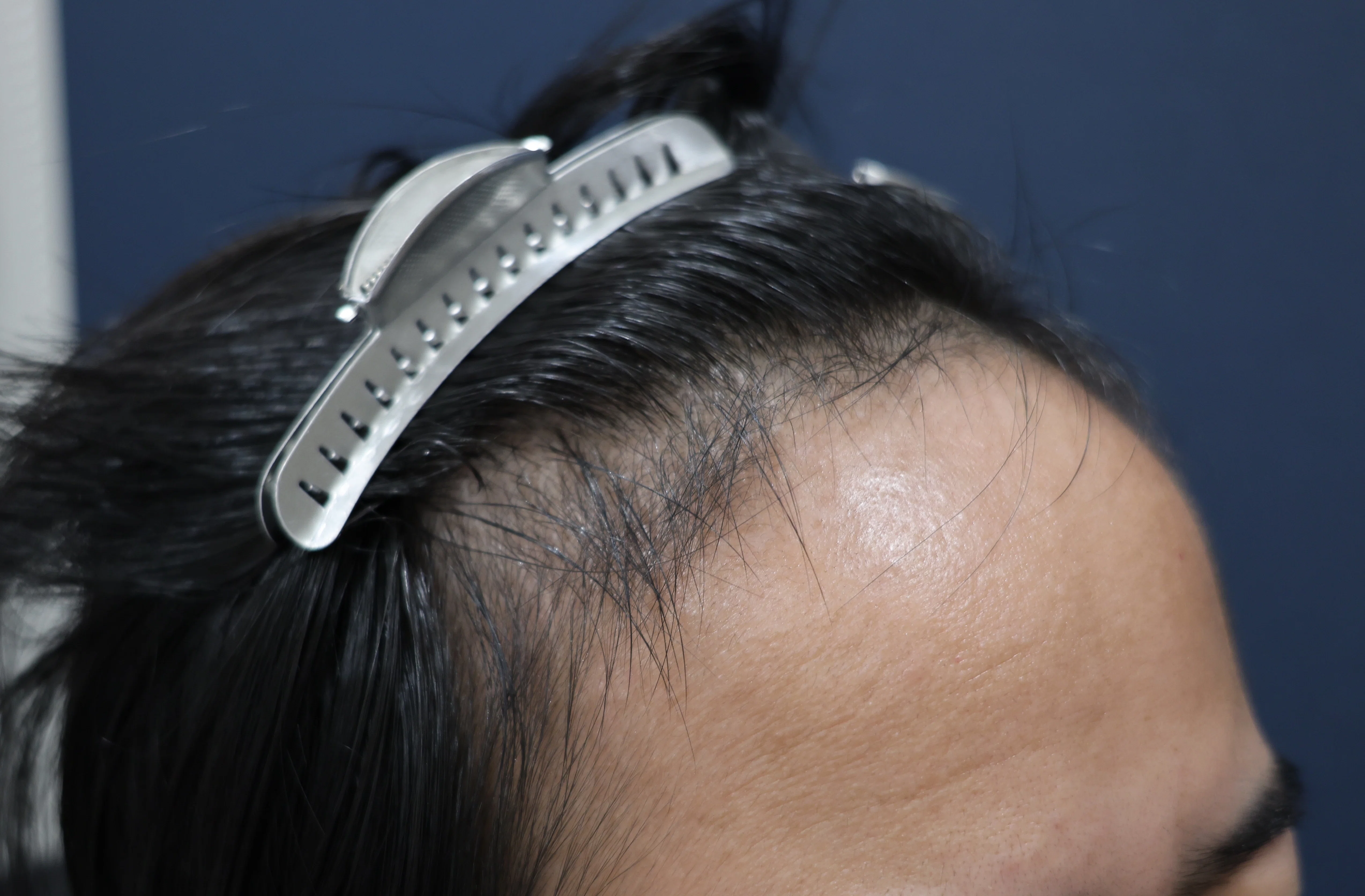 [Case Study 9] Hair Transplantation, Almo Hi-STANDARD Method, 1900 ...