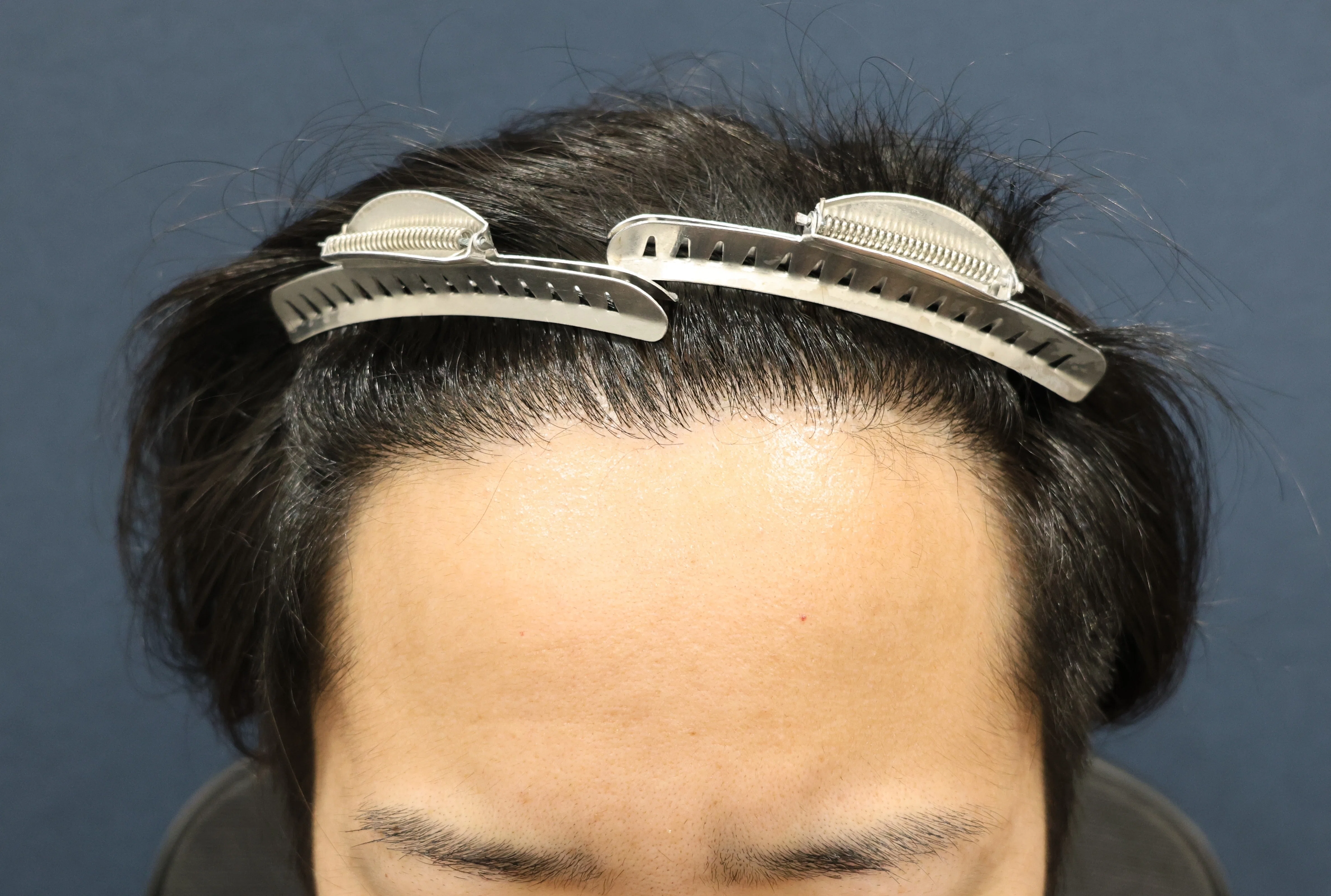 [Case Study 9] Hair Transplantation, Almo Hi-STANDARD Method, 1900 ...