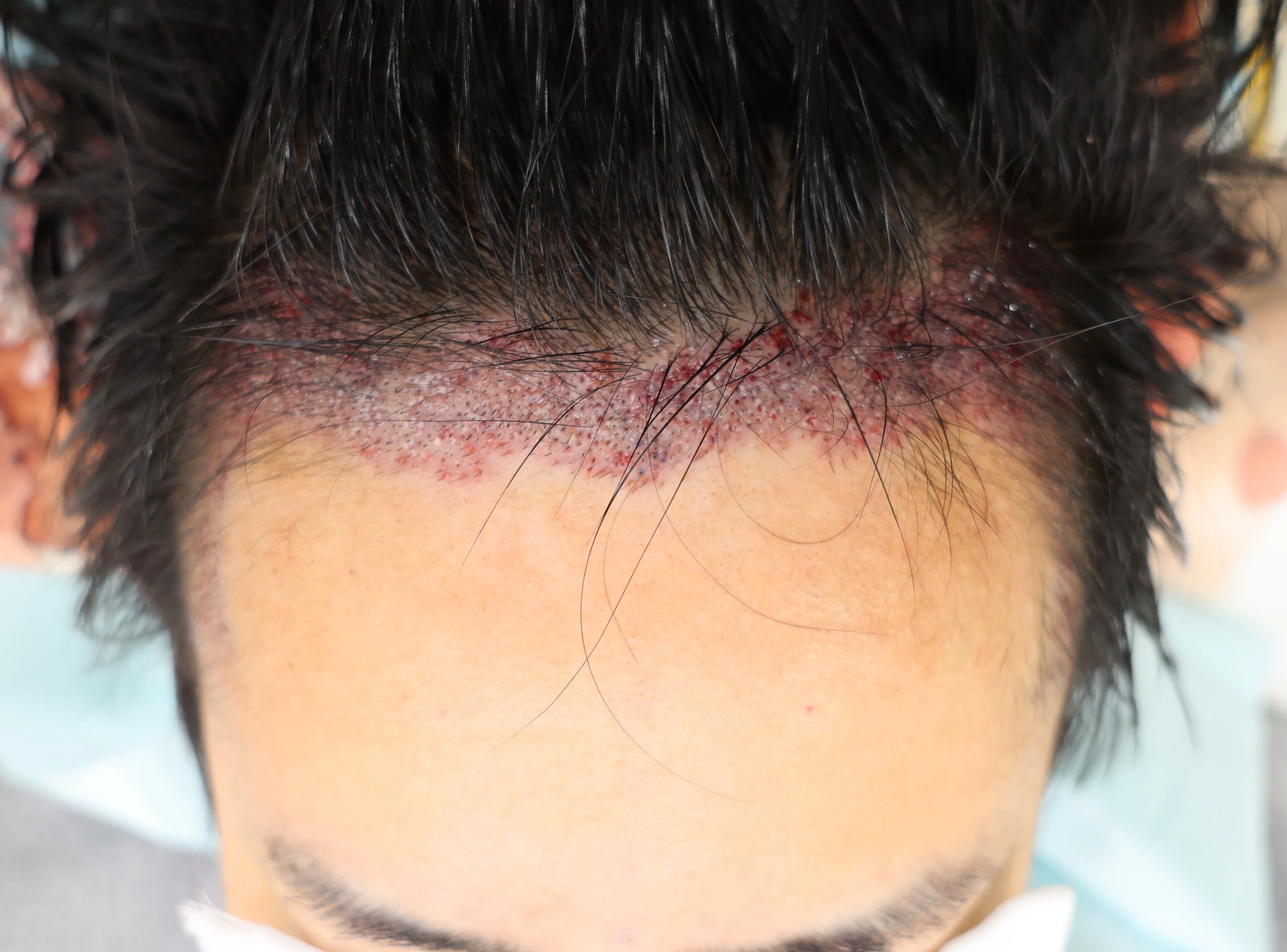 [Case Study 9] Hair Transplantation, Almo Hi-STANDARD Method, 1900 ...