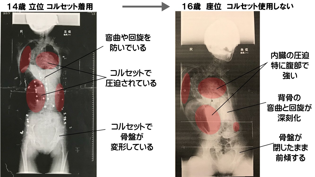 知力の背骨 苛立ち」が続くと、 背骨の真ん中がこわばってきます。 消化力を弱ら