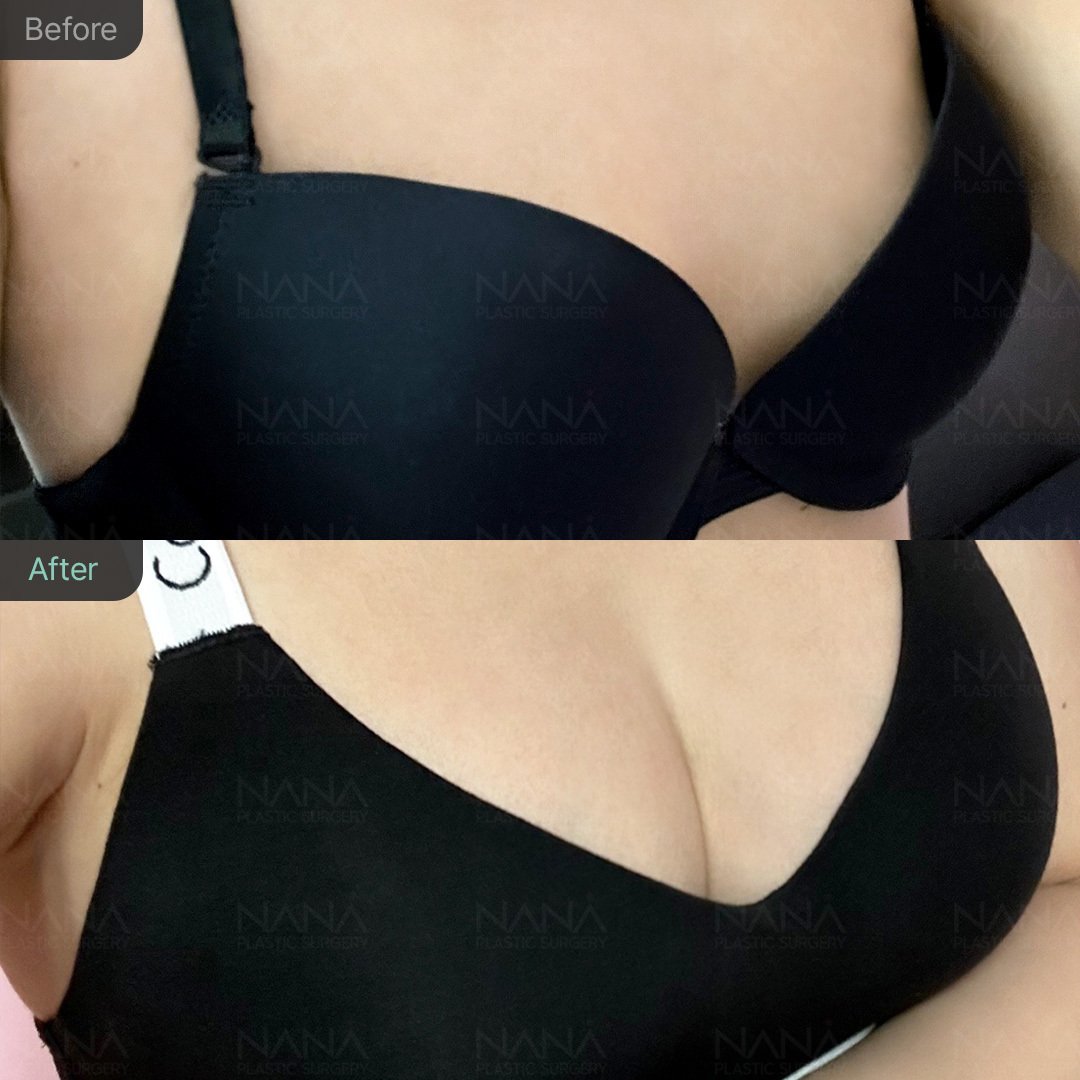 NANA豊胸手術⭐Before&After⭐症例写真｜韓国整形NANA美容外科