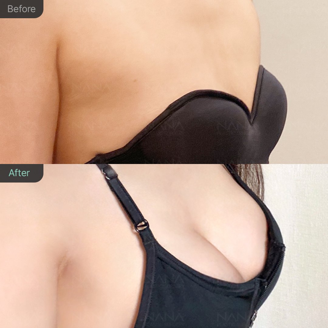NANA豊胸手術⭐Before&After⭐症例写真｜韓国整形NANA美容外科