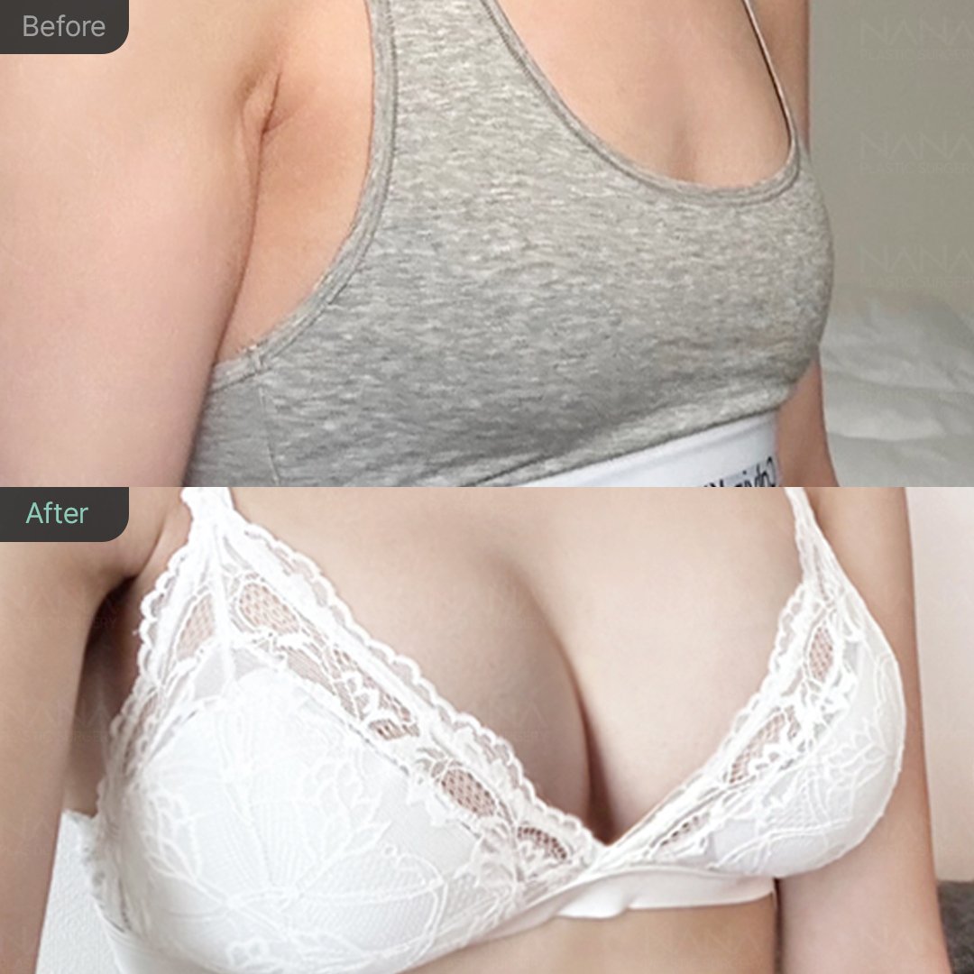 NANA豊胸手術⭐Before&After⭐症例写真｜韓国整形NANA美容外科