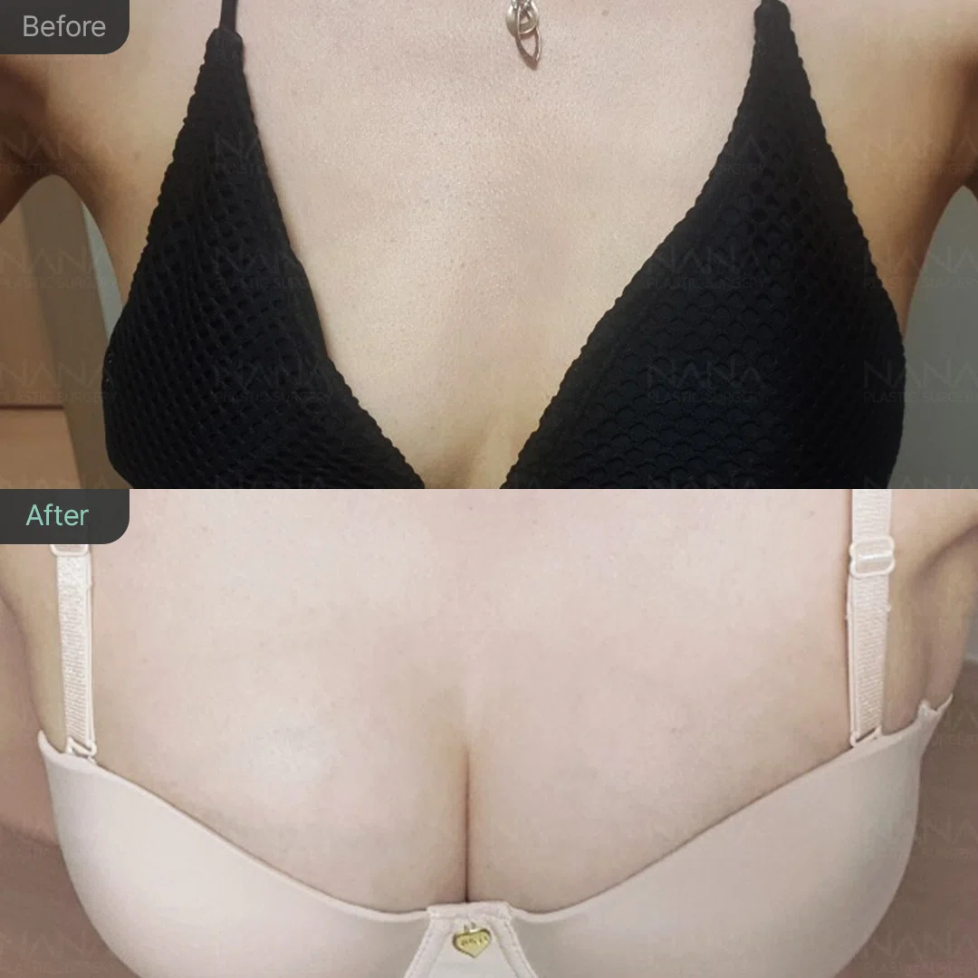 NANA豊胸手術⭐Before&After⭐症例写真｜韓国整形NANA美容外科