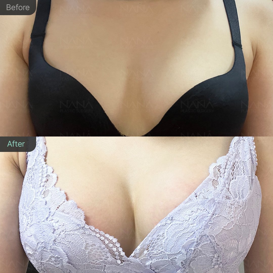NANA豊胸手術⭐Before&After⭐症例写真｜韓国整形NANA美容外科