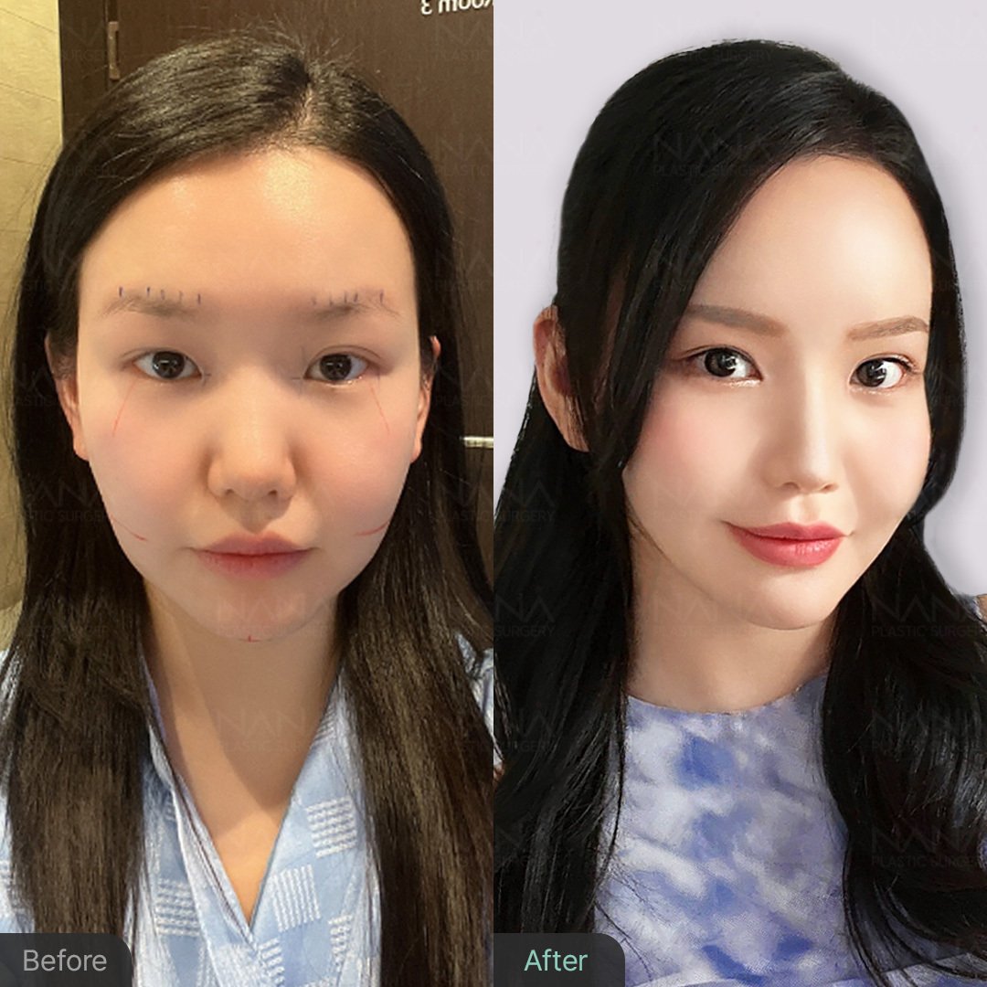 NANA輪郭整形⭐Before&After⭐症例写真①｜韓国整形NANA美容外科