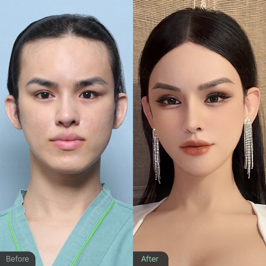 韓国整形　韓国美容　韓国美容外科　顔面輪郭　輪郭手術　Vライン形成　頬骨縮小　エラ削り　顎先縮小