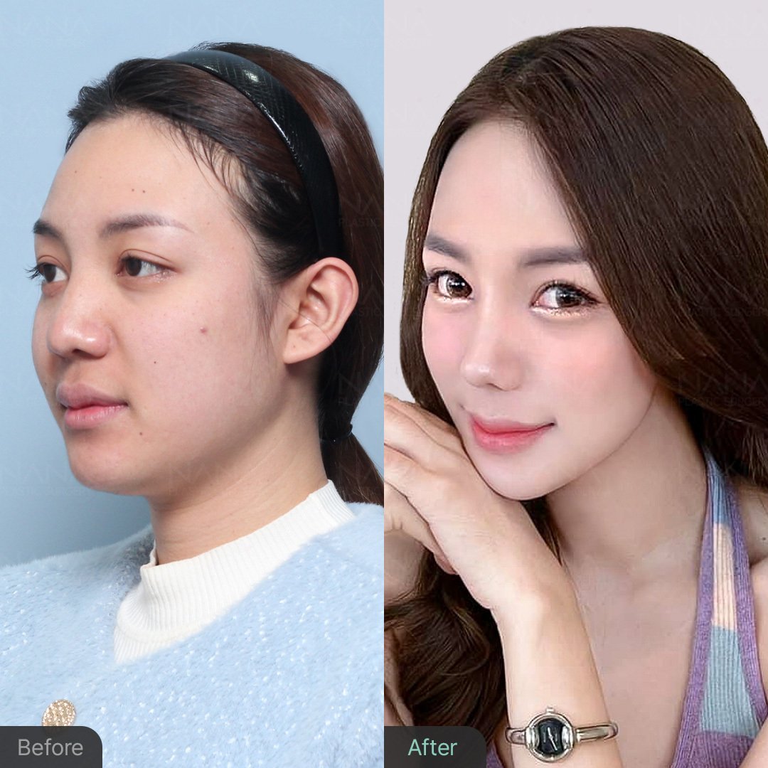 EVERA　韓国　美容　豊胸　美容整形　エベラ o0776035214815885284.jpg