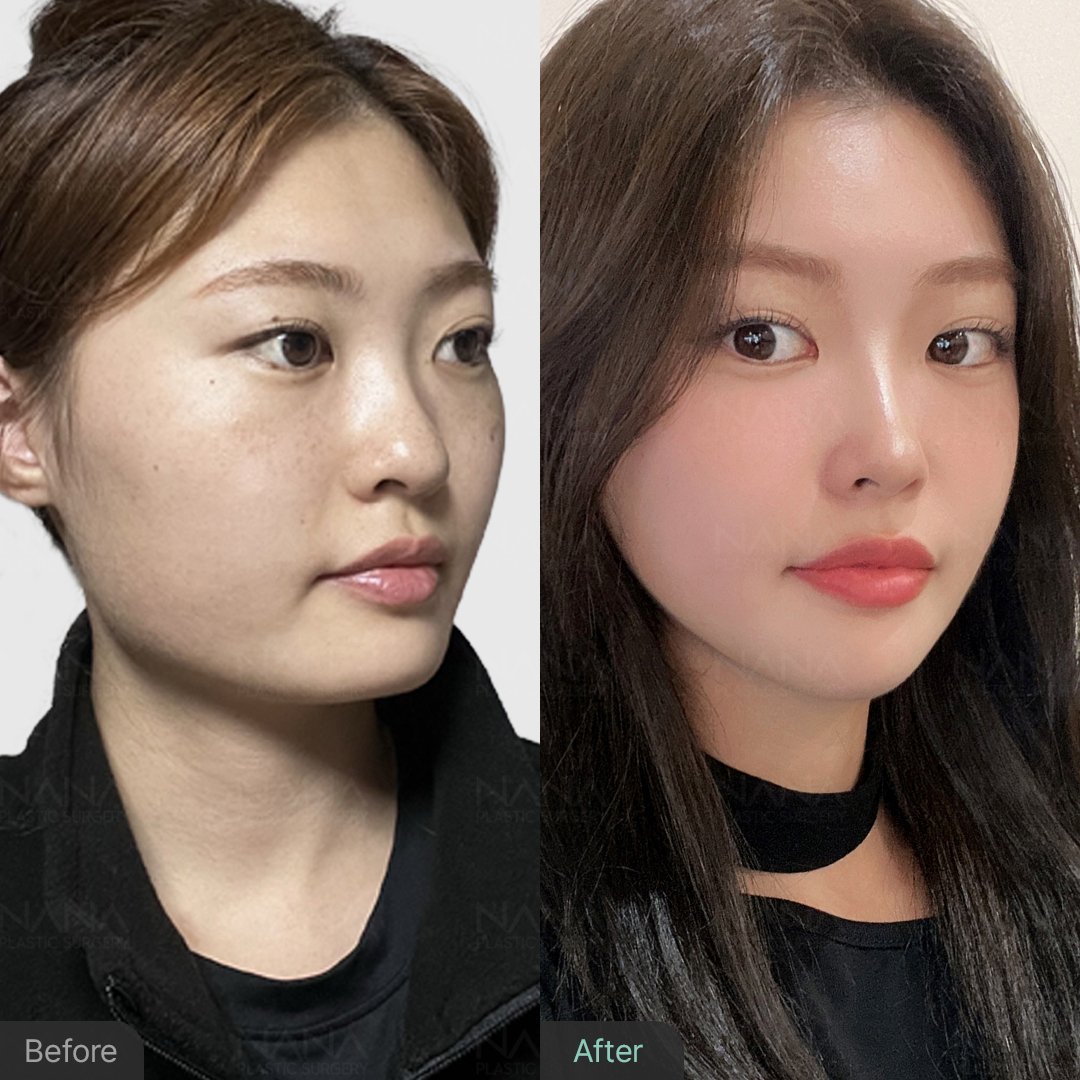 韓国整形　韓国美容　韓国美容外科　顔面輪郭　輪郭手術　Vライン形成　頬骨縮小　エラ削り　顎先縮小