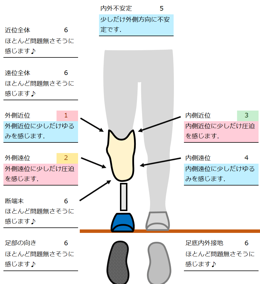 下腿義足：外側方向の不安定感2｜GAIT ASSIST