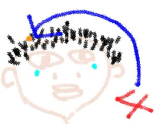 前頭部に皮膚癌１か所