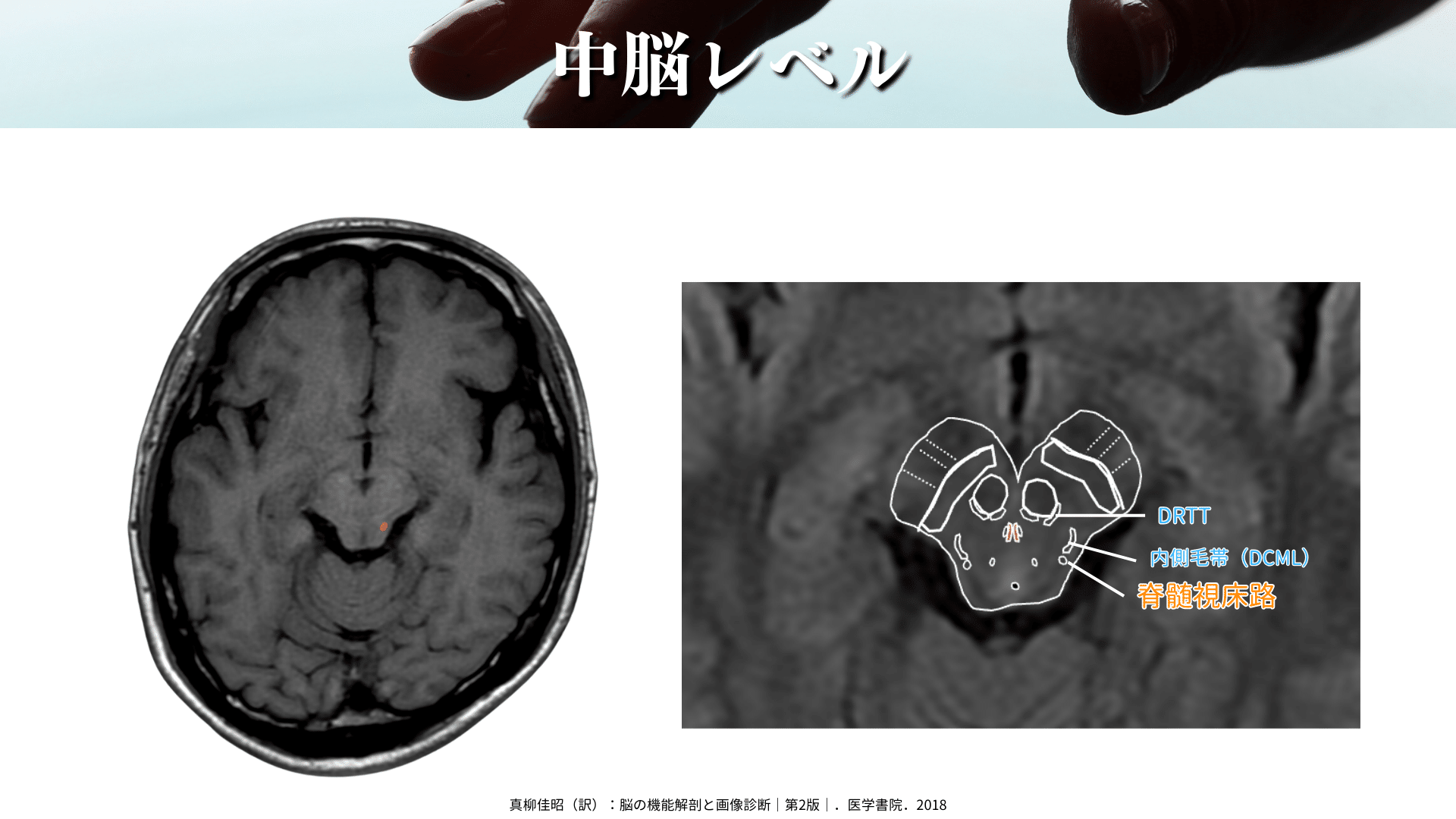 脳の機能解剖と画像診断 第2版 脳の機能解剖と画像診断 第2版 | 眞柳 佳昭 |本 | 通販 | Amazon