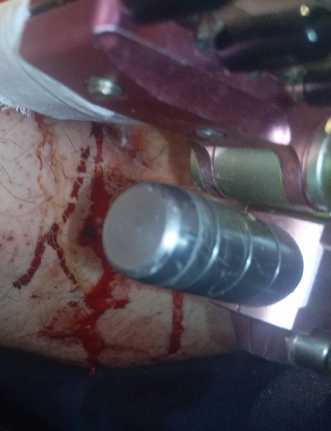 BONE FRACTURE by yonsei kim & chung orthopedic clinic PT