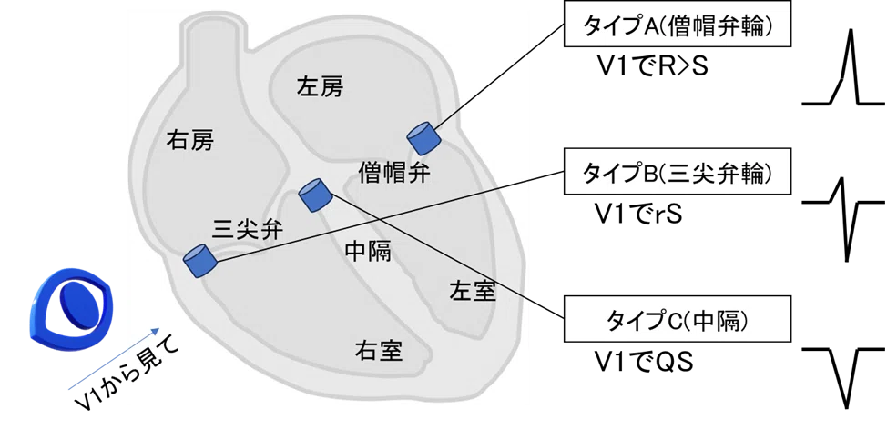 ケント束の部位を2stepで鑑別する – 心電図マイスターの酒場
