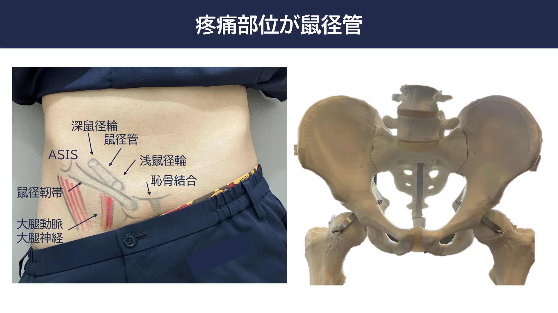 投球動作における鼠径部痛の病態とアプローチ -Groin pain syndrome編 投球動作における鼠径部痛の病態とアプローチ -Groin pain syndrome編