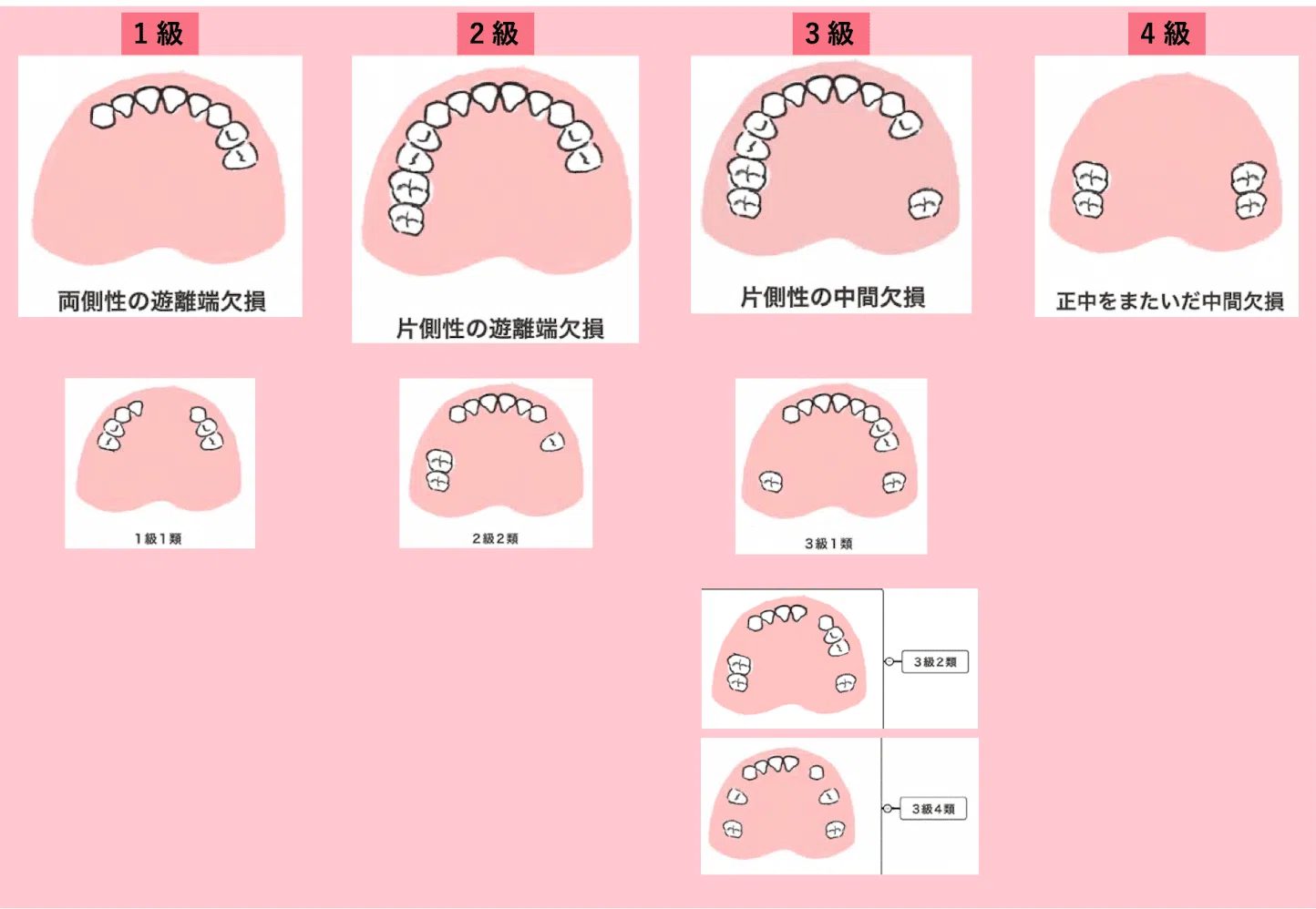 欠損補綴治療なら葛西の歯医者 ☆希少！ 『 症例でみる欠損歯列・欠損