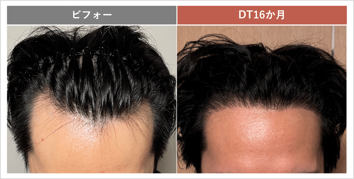 Dr.今川の植毛体験記 専門医が自分の髪で実践したドキュメント 最先端の自毛植… Dr.今川の植毛体験記 専門医が自分の髪で実践したドキュメント