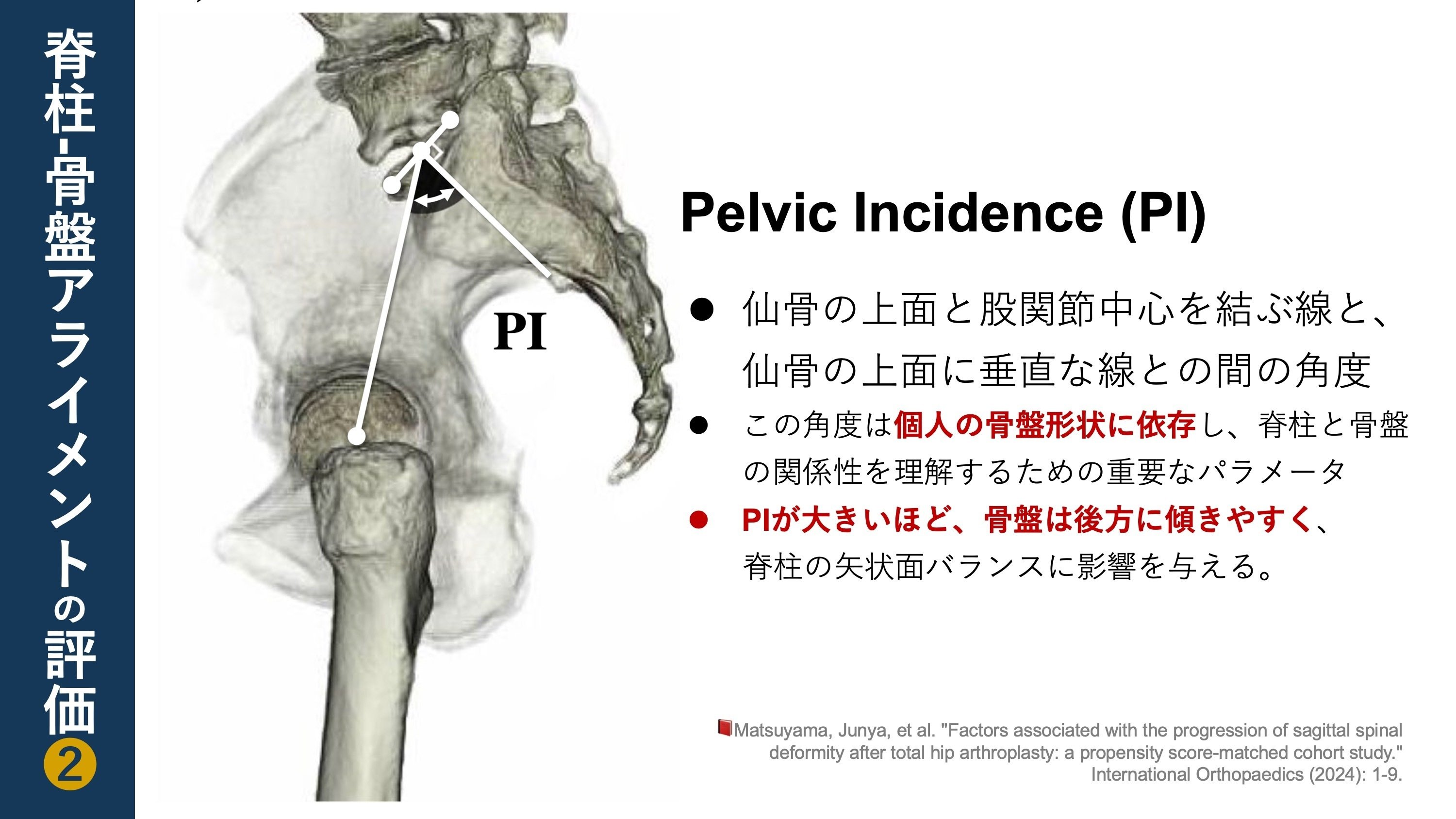 THA後の不良な矢状面姿勢。骨盤の形状が関連していた|Super THA後の不良な矢状面姿勢。骨盤の形状が関連していた|Super