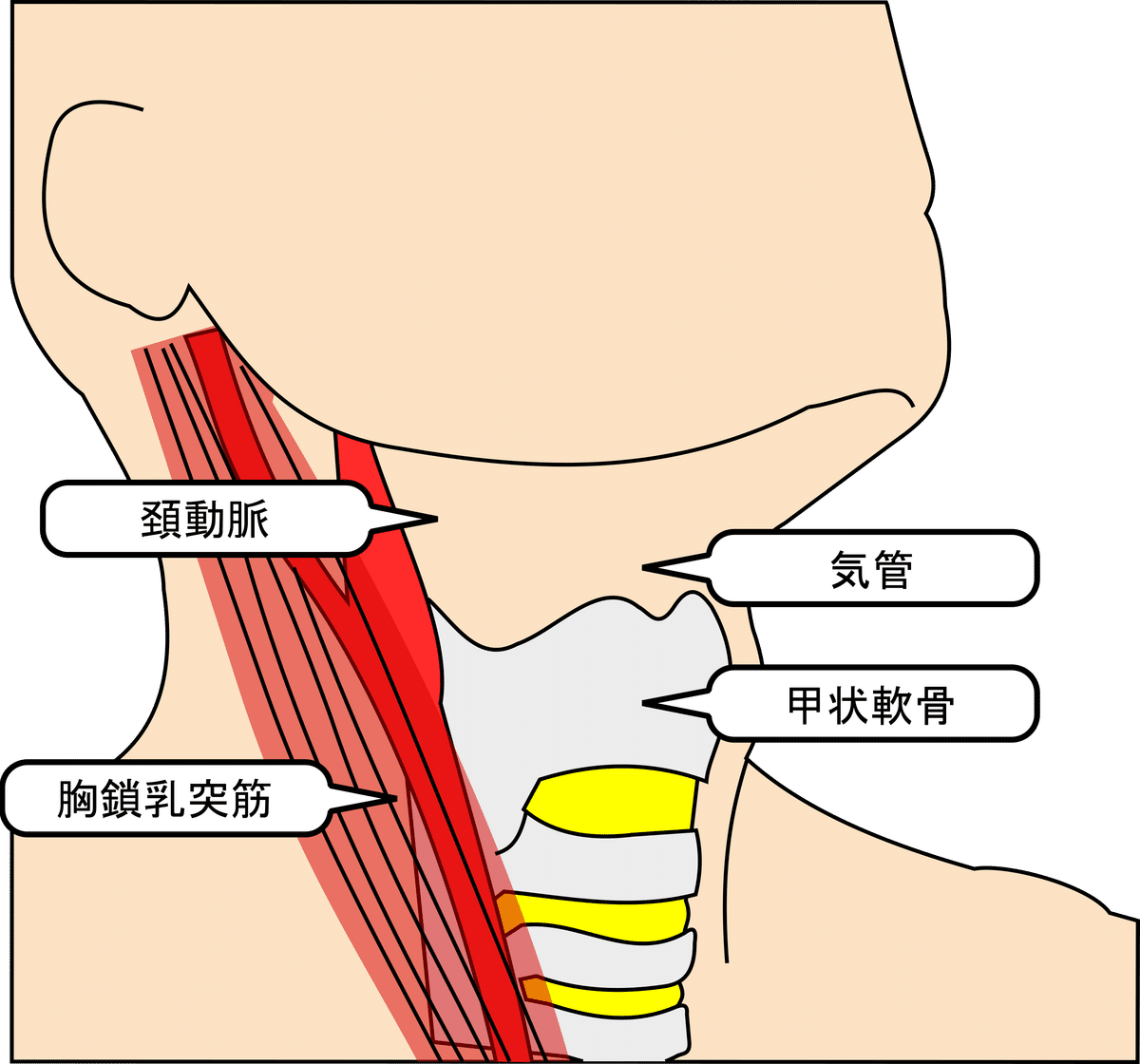 脳梗塞 ＃5-8 CEA（頚動脈内膜剥離術）｜脳卒中