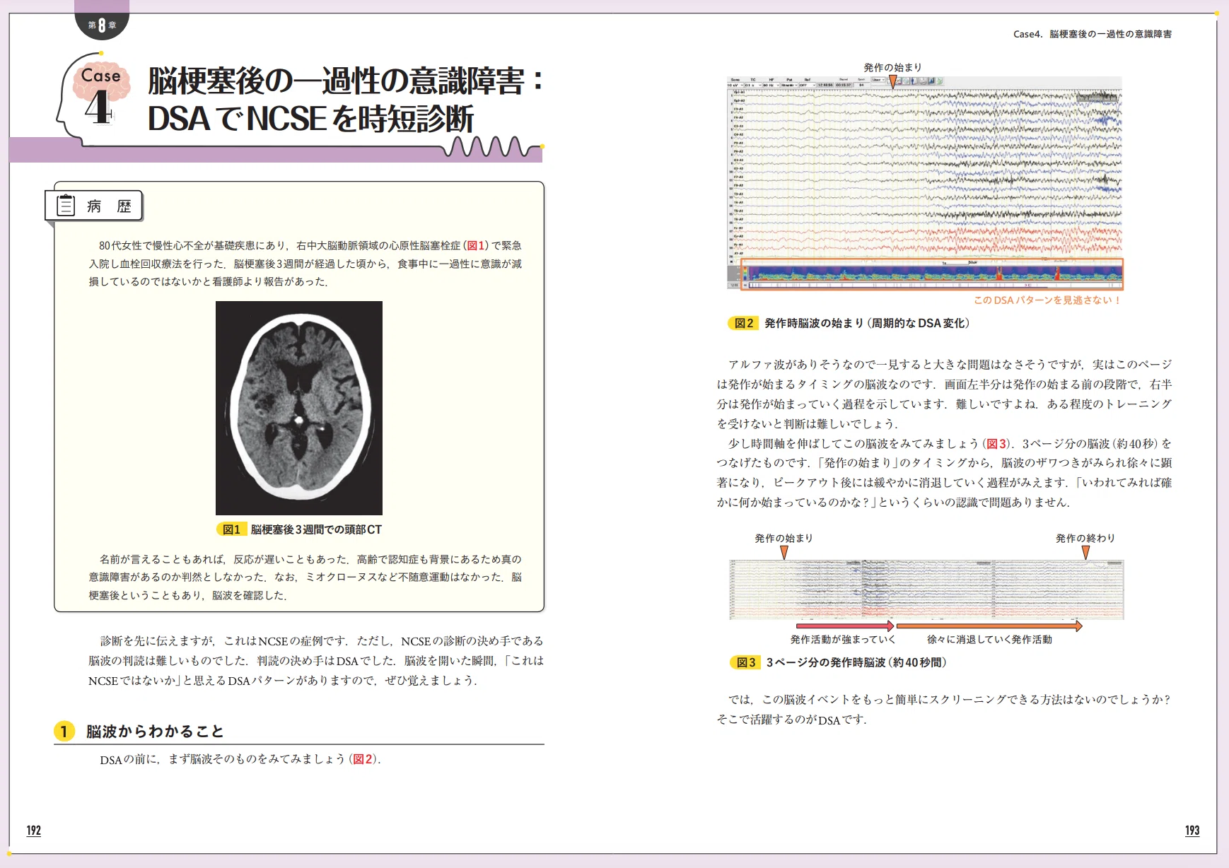 はじめての脳波トリアージ - 2ステップで意識障害に強くなる