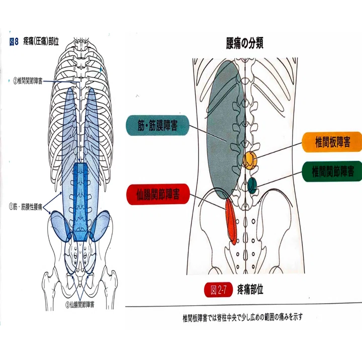 腰痛の要因は大きく5つ！腰痛の治療【概論】~腰痛の要因と評価でそれ