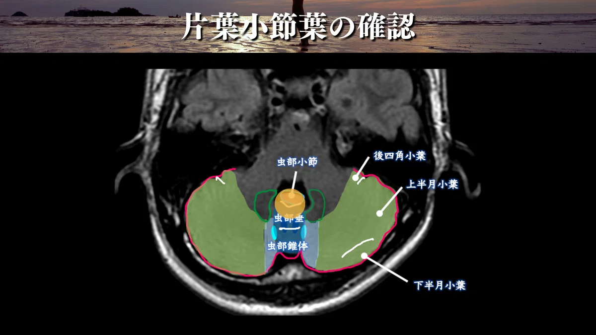 前庭脊髄路の走行と機能をまとめてみた｜サギョウ先生