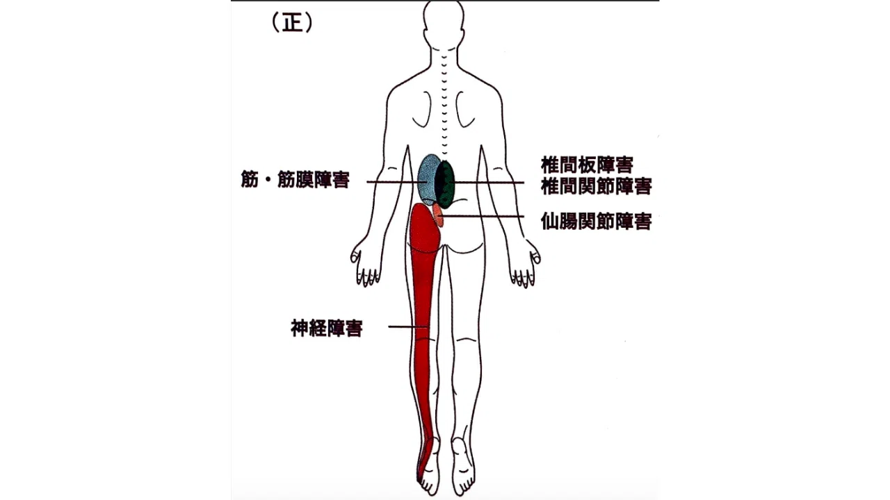 腰痛の要因は大きく5つ！腰痛の治療【概論】~腰痛の要因と評価でそれ