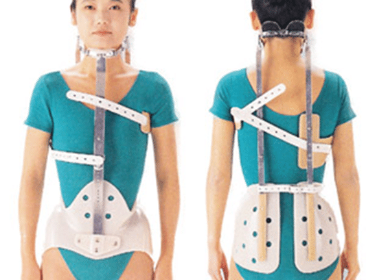 装具学 体幹装具 まとめ 側弯症用装具｜じょんがらPT