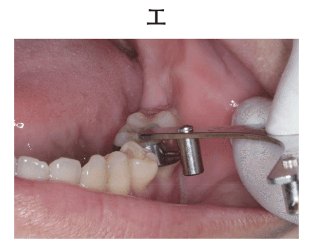 ブラケットポジショニング 解説と実践 ブラケットポジショニング 解説と実践