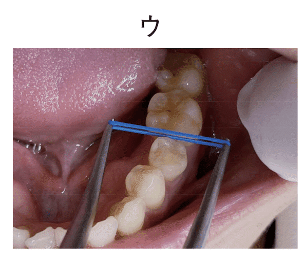 ブラケットポジショニング 解説と実践 ブラケット ポジショニングゲージ − 製品情報｜OralStudio