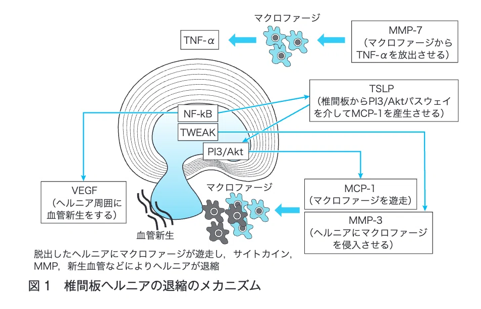 椎間板ヘルニアが自然退縮する免疫学的機序を示した図。マクロファージの遊走と血管新生の流れ