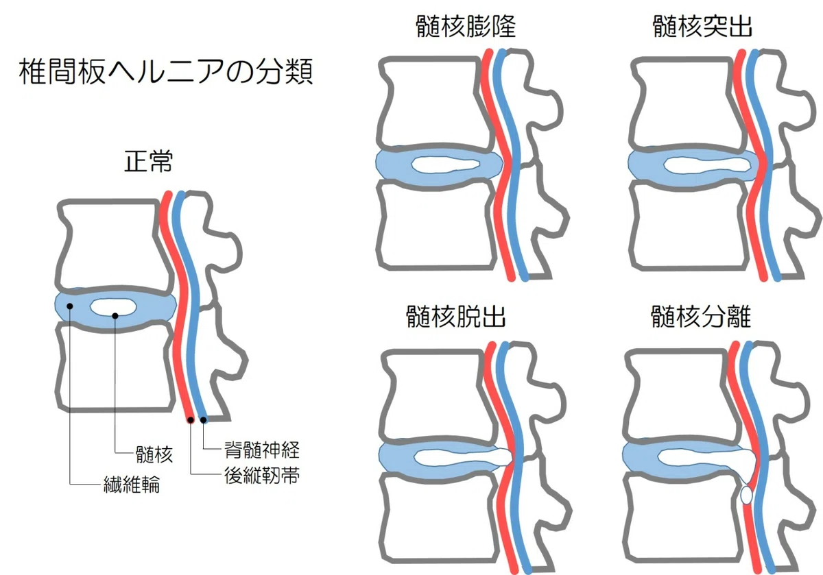 椎間板ヘルニアの4つのタイプ（髄核膨隆・突出・脱出・分離）を断面図で示した分類図