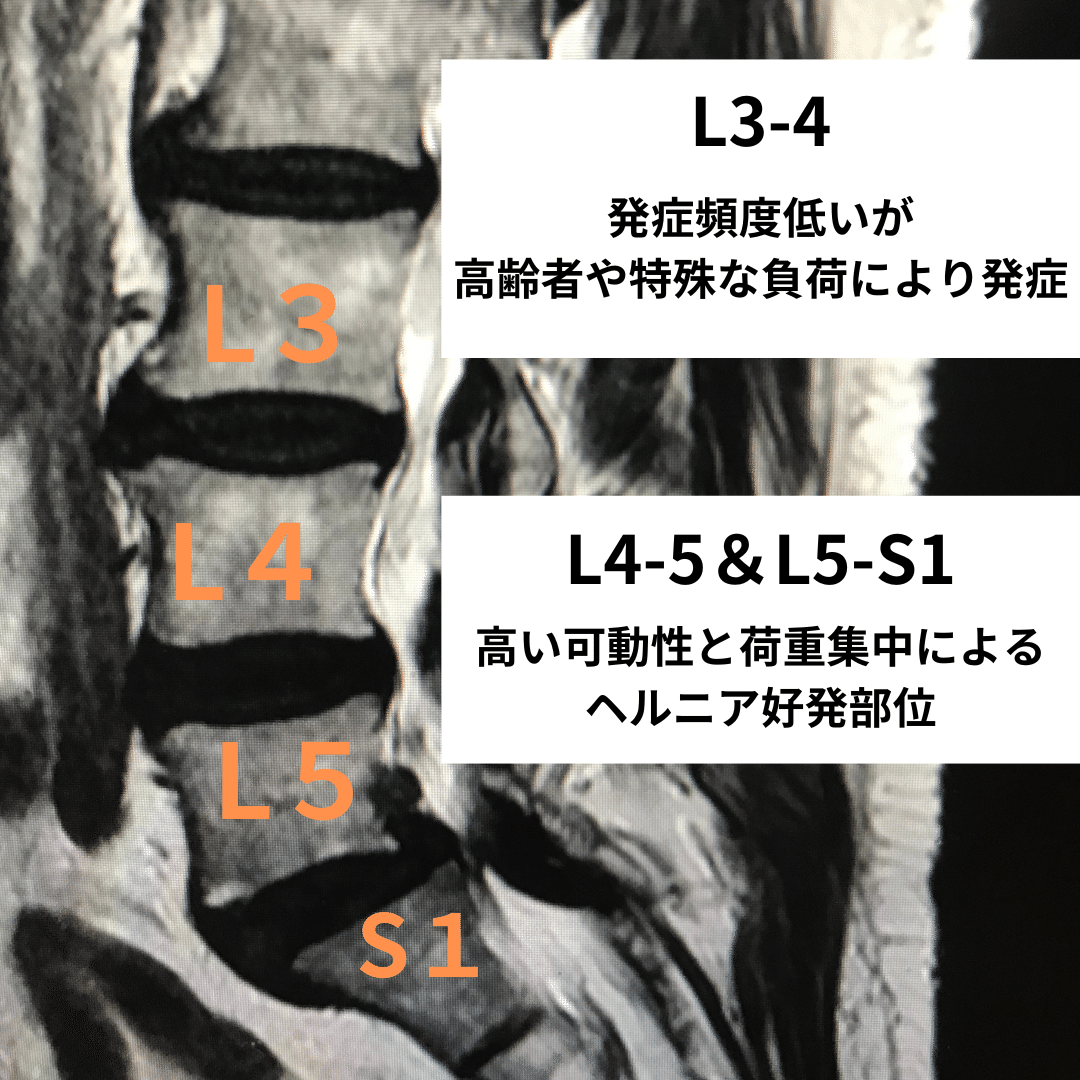 新人PTが知るべき腰椎椎間板ヘルニア｜齋藤将司｜腰痛治療の始め方