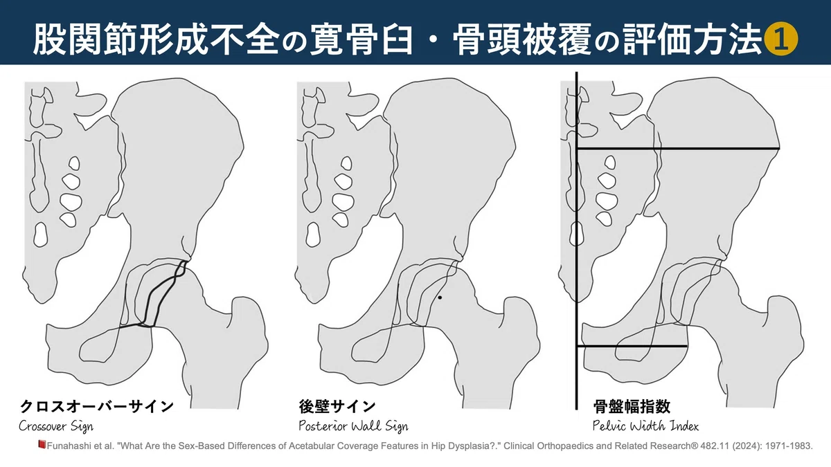 股関節形成不全の寛骨臼・骨頭被覆の評価方法12選|Super Human | 理学療法士/保健学博士 Ph.D.