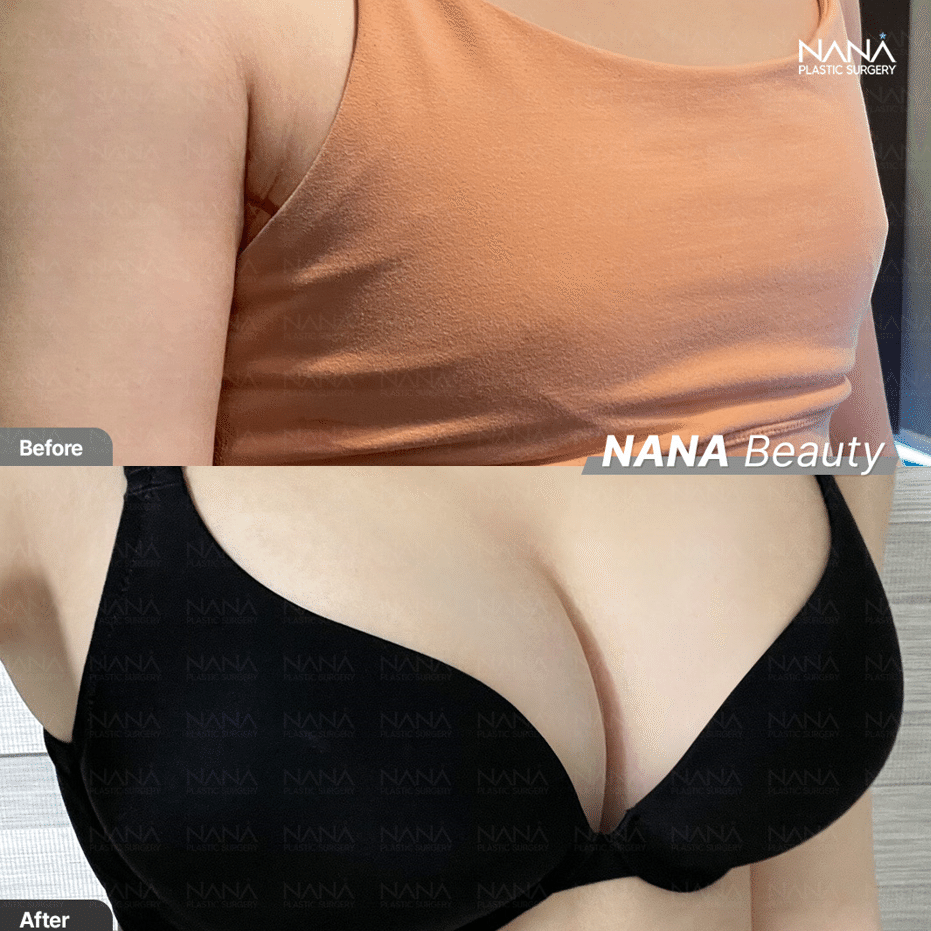 EVERA　韓国　美容　豊胸　美容整形　エベラ ✓NANAベラジェル豊胸術 胸についてお悩みの方❣❣ ファン院長は