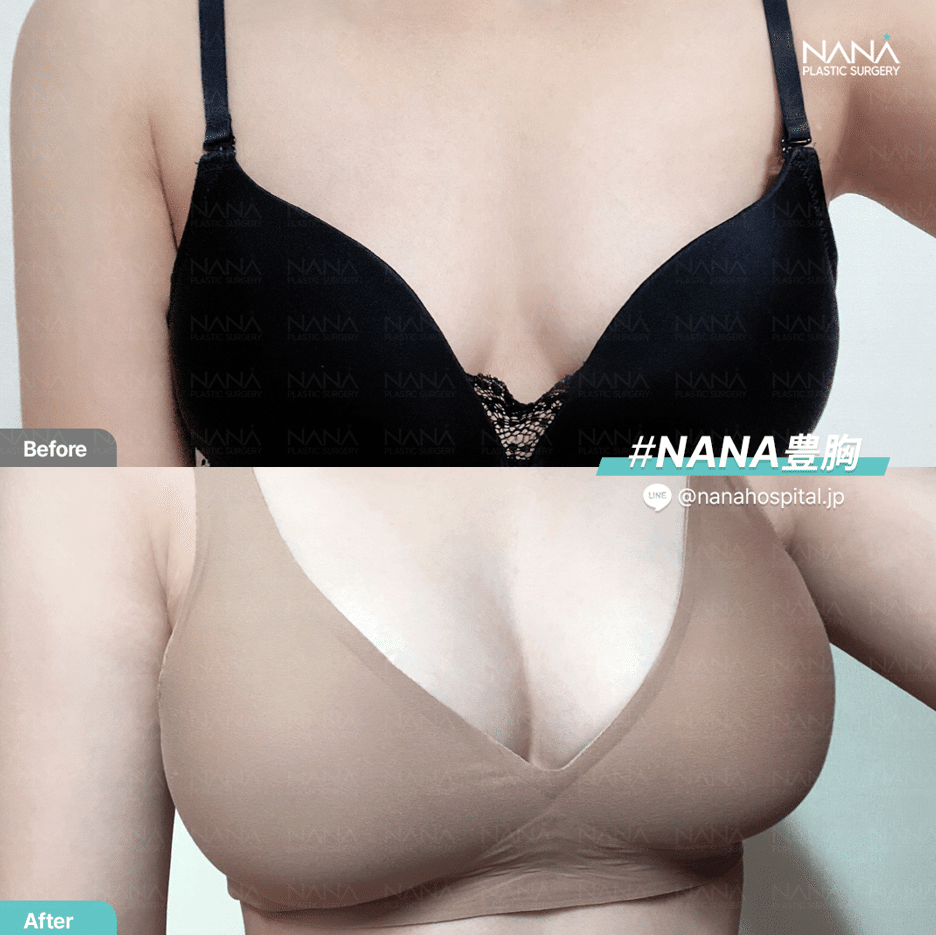 豊胸手術は10年後に再手術が必要！？｜韓国整形NANA美容外科