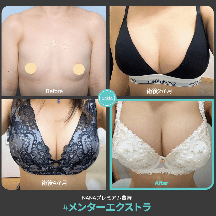 豊胸手術は10年後に再手術が必要！？｜韓国整形NANA美容外科