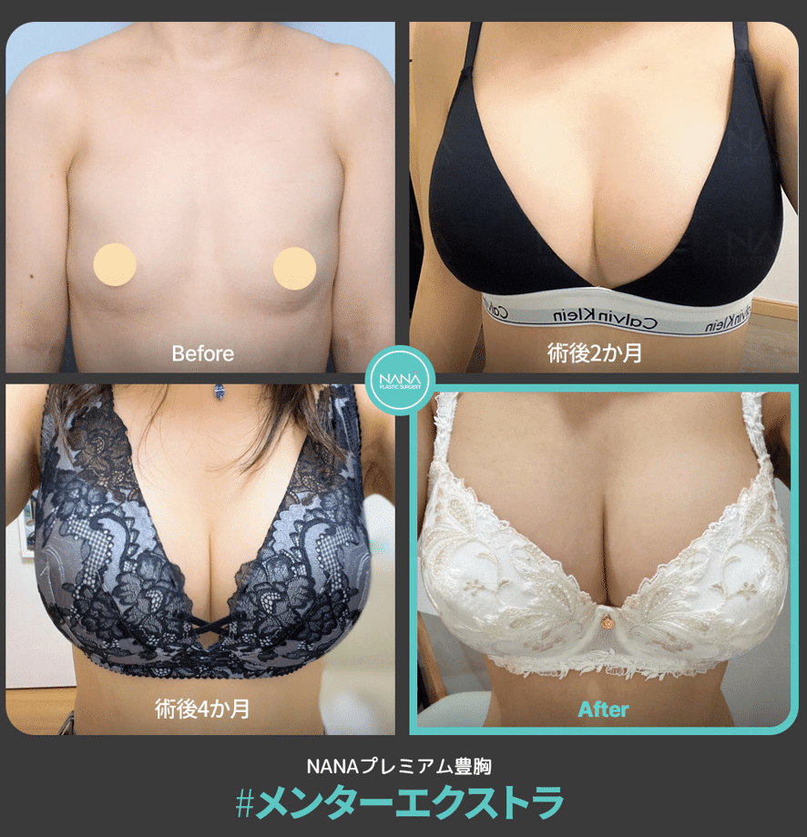 豊胸手術は10年後に再手術が必要！？｜韓国整形NANA美容外科