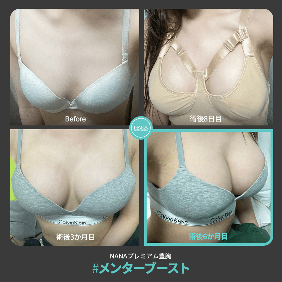 豊胸手術は10年後に再手術が必要！？｜韓国整形NANA美容外科