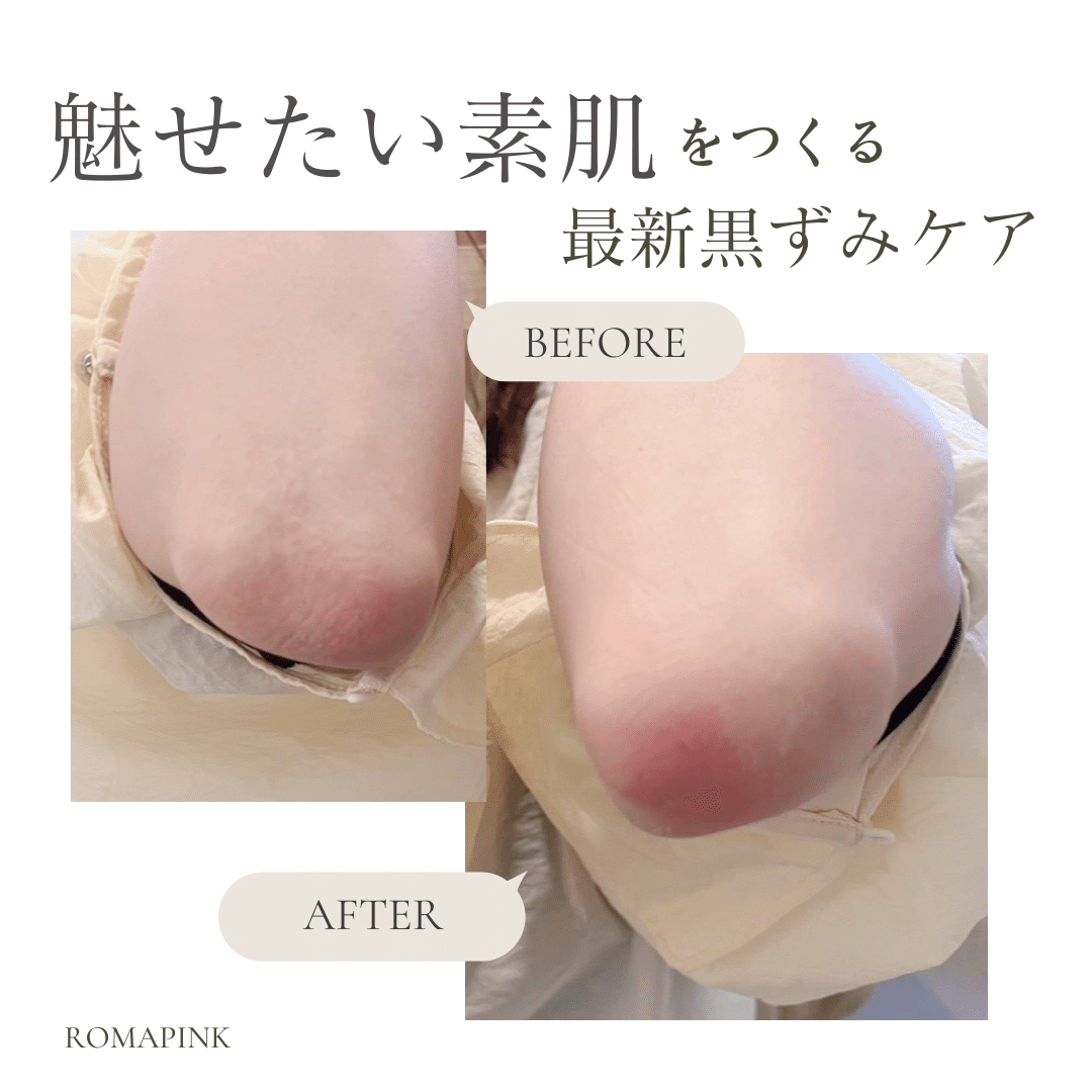 ローマピンクという新技術！！｜shu-salon