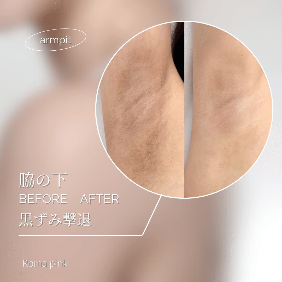 ローマピンクという新技術！！｜shu-salon