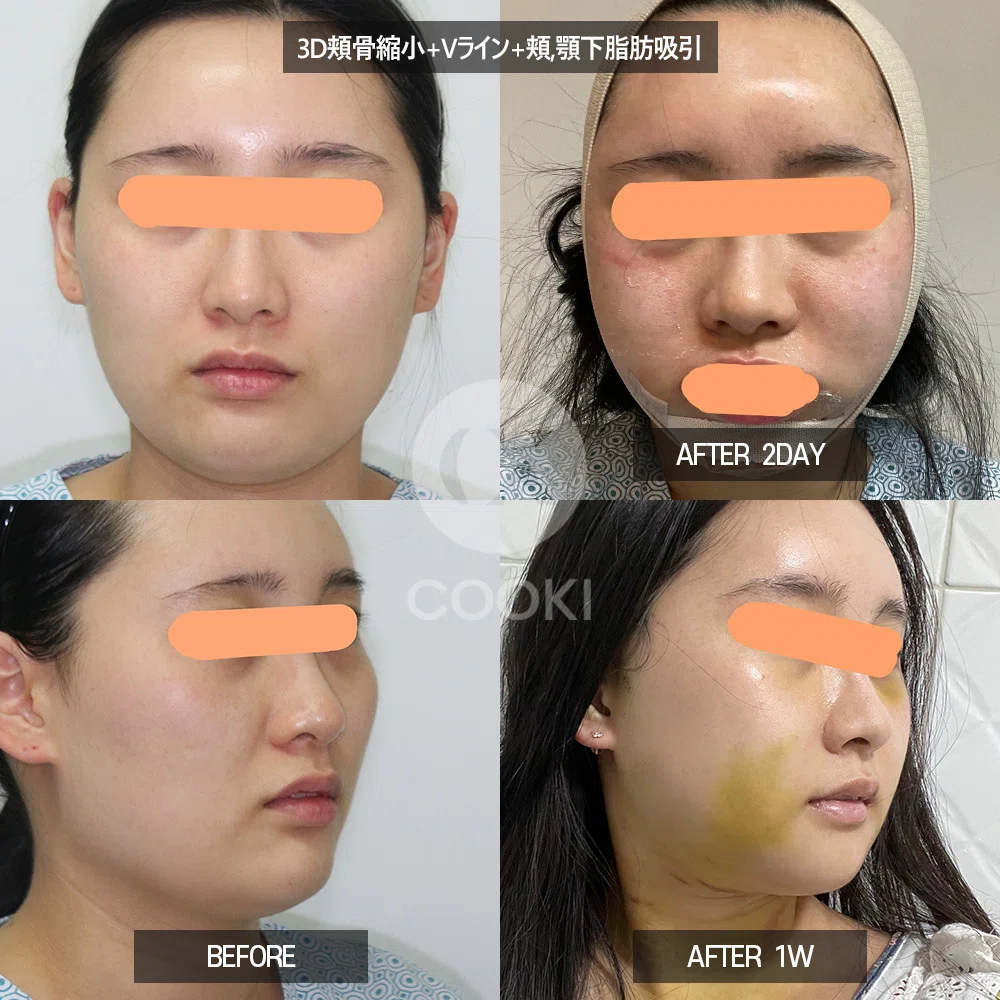 [Before and After Facial Liposuction] Synergy boost when combined with ...