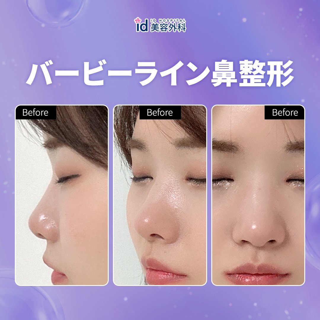 鼻手術で雰囲気美女から芸能人級の美女に大変身！idのリアルストーリー！｜[公式] id美容外科, image size:1080x1080