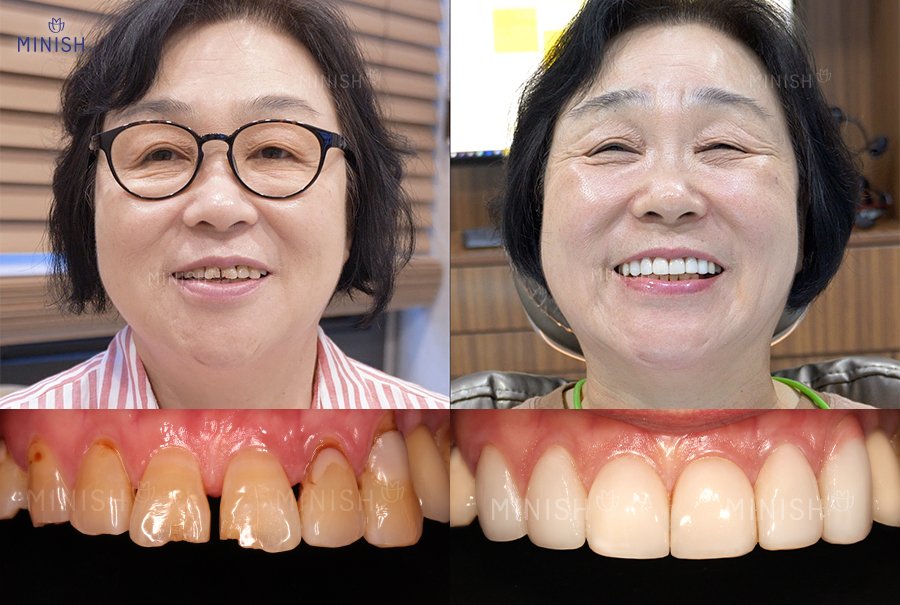 歳月には勝てない？歯のアンチエイジングもミニッシュで｜ミニッシュJAPAN