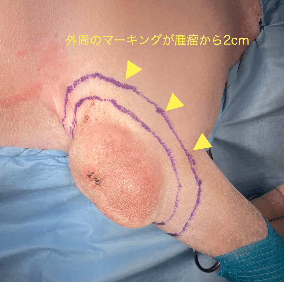 手術note25 肘部の軟部組織肉腫の摘出（胸背動脈皮弁の使用