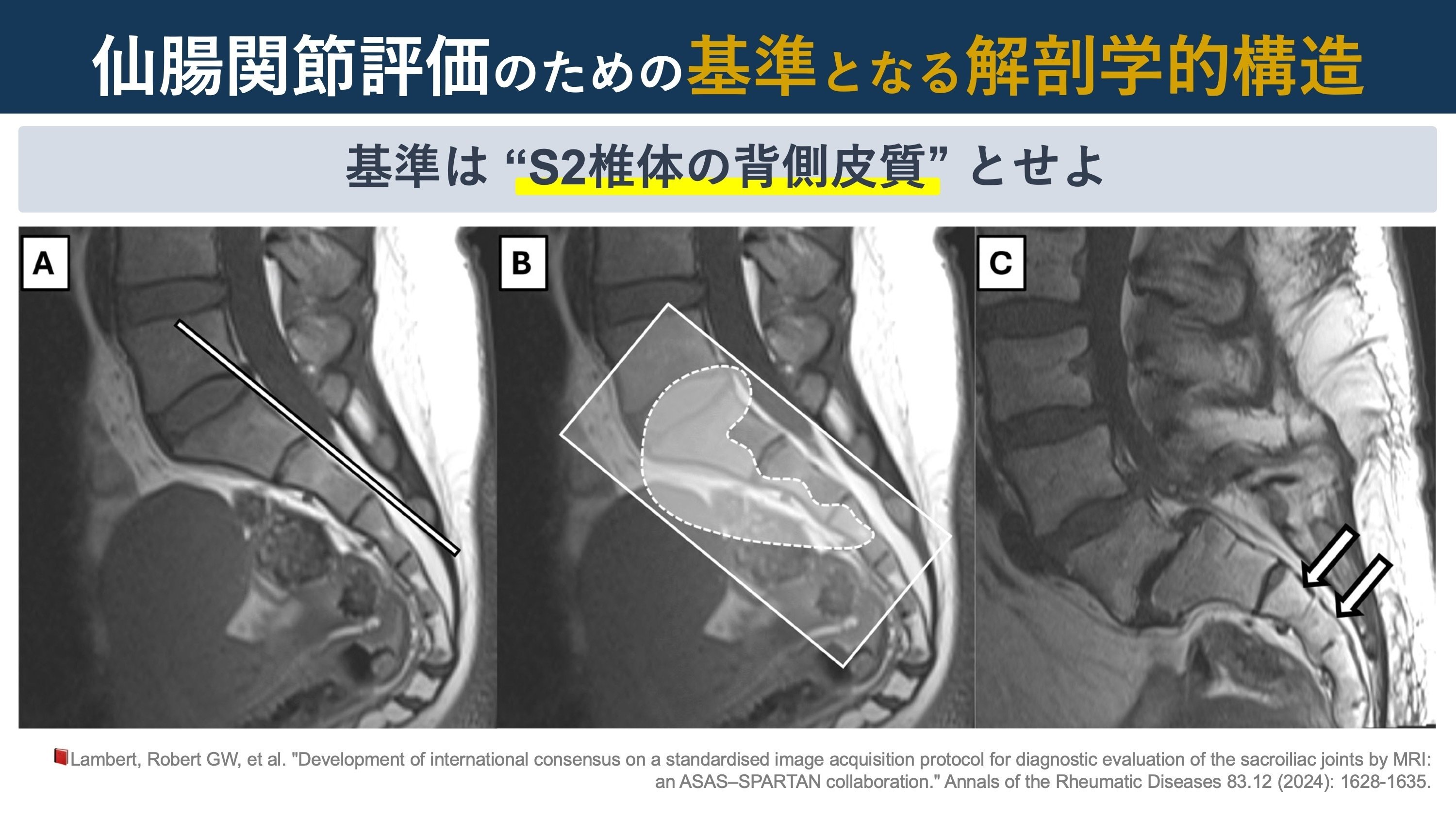 仙腸関節の画像評価|Super Human | 理学療法士/保健学博士 Ph.D. 仙腸関節の画像評価|Super Human | 理学療法士/保健学博士 Ph.D.