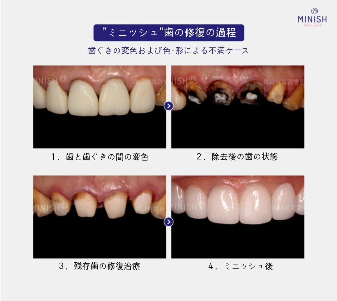 ラミネートの再治療について悩んでいるなら？｜ミニッシュJAPAN