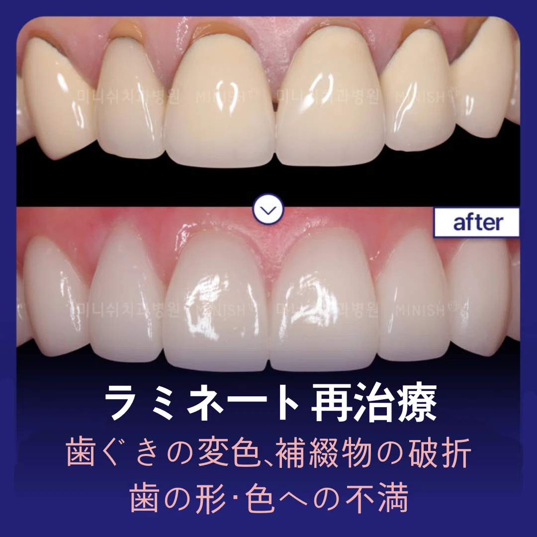 ラミネートの再治療について悩んでいるなら？｜ミニッシュJAPAN